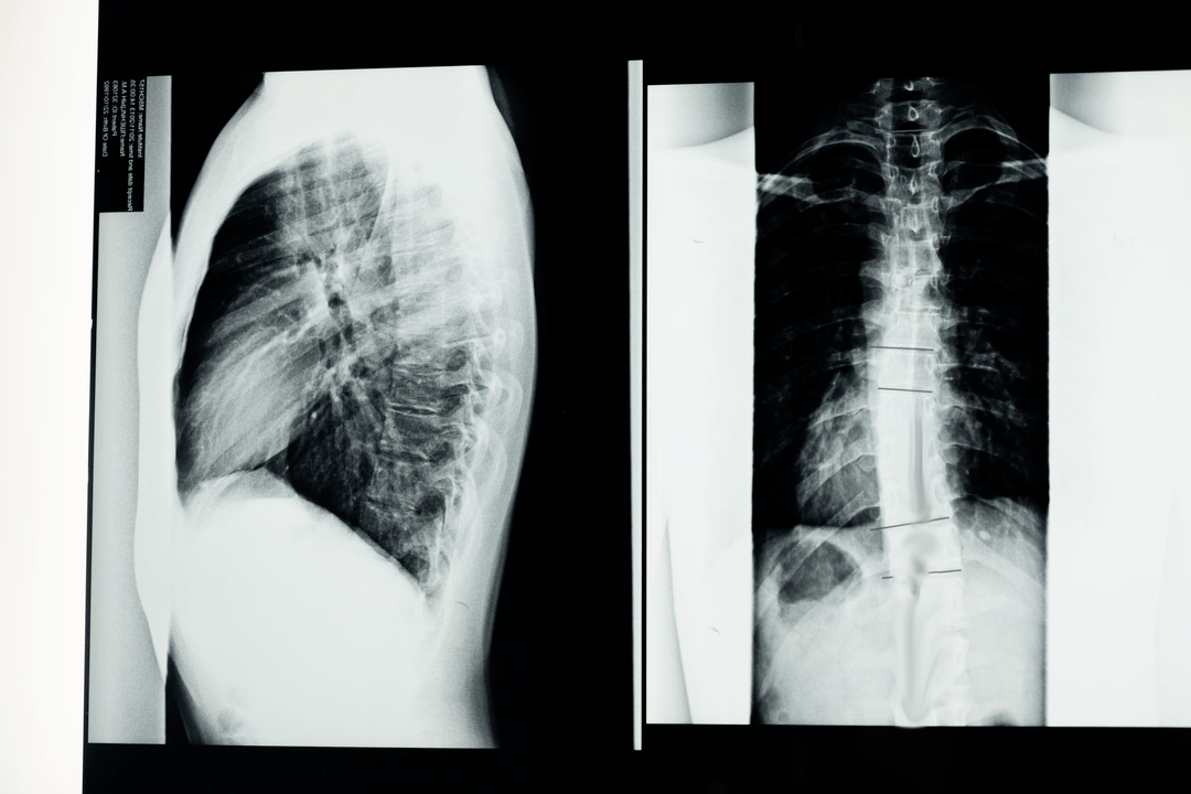 پوکی استخوان ستون فقرات گردنی در تصویر