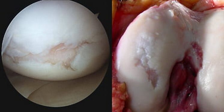 آسیب به مفصل زانو در حین عمل قابل مشاهده است
