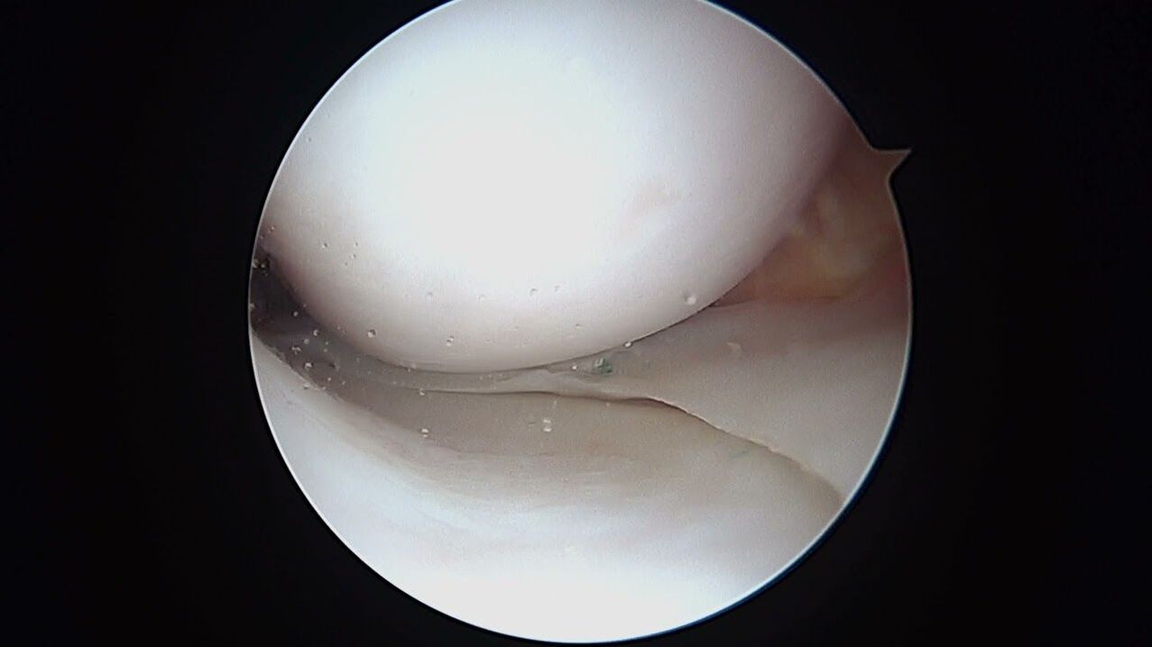 نمای مفصل زانو از طریق آرتروسکوپ