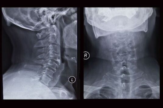 تصویر اشعه ایکس از ستون فقرات گردنی (بیمار مبتلا به پوکی استخوان است)