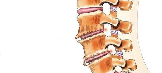 اسپوندیلوز - تخریب مفاصل بین مهره ای