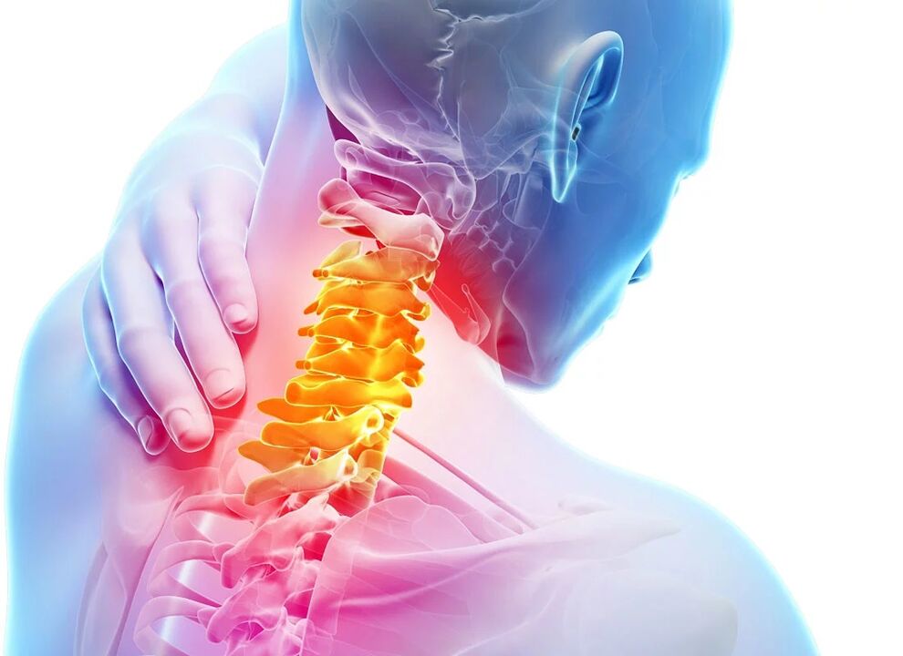 استئوکندروز گردن رحم