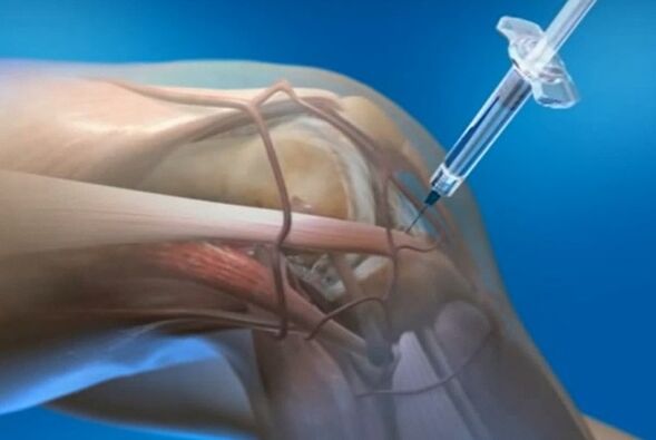 تزریق داخل مفصلی برای آرتروز مفصل زانو